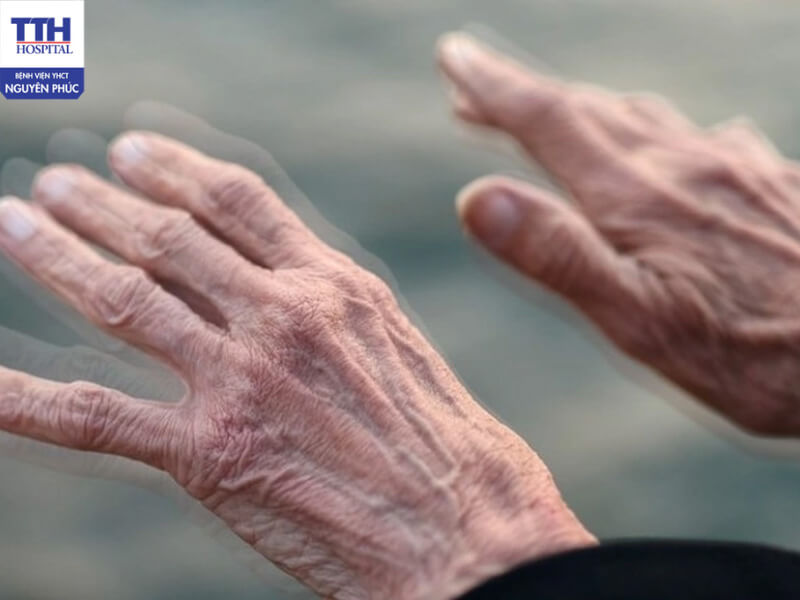 Bệnh Parkinson là một dạng rối loạn thần kinh chủ yếu ảnh hưởng đến khả năng vận động