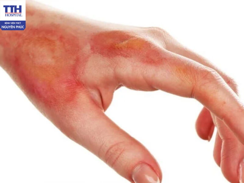 Bỏng và tổn thương mô mềm: Những tình trạng không thể chủ quan