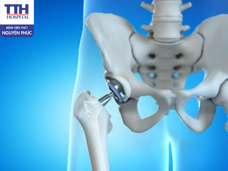 Các chỉ định thay khớp háng nhân tạo