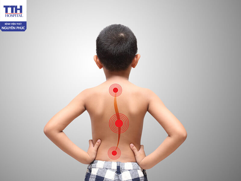 Cong vẹo cột sống ở trẻ là gì?
