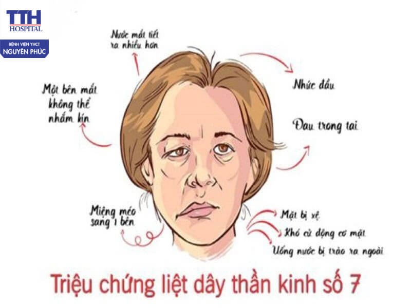 Dấu hiệu nhận biết liệt dây thần kinh số VII ngoại biên