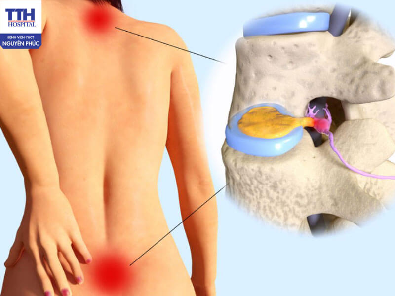 Dấu hiệu nhận biết thoát vị đĩa đệm ở dân văn phòng