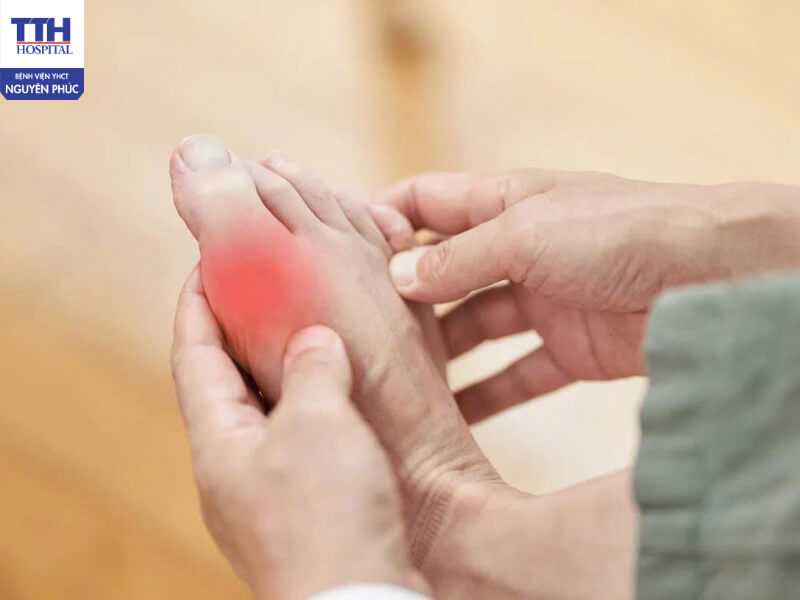 Giai đoạn 2: Cơn gout cấp tính