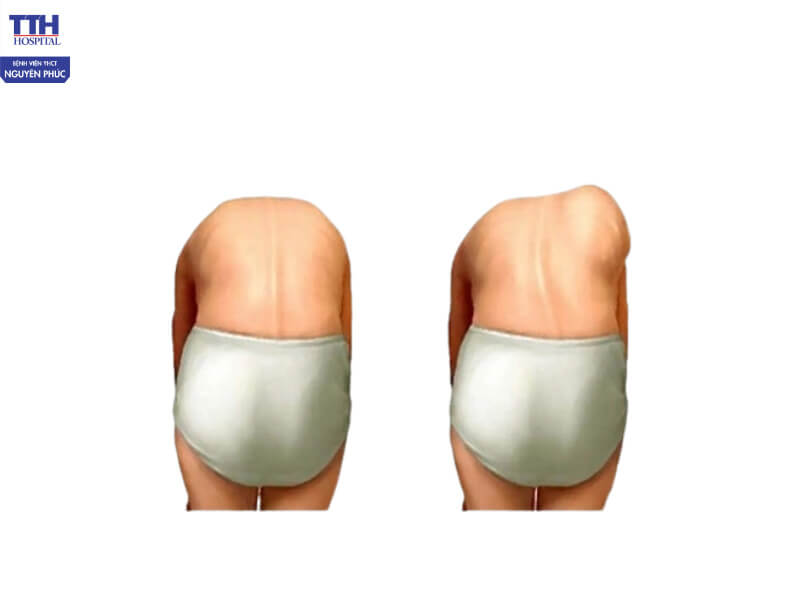 Gợi ý 3 cách phát hiện cong vẹo cột sống ở trẻ ngay tại nhà