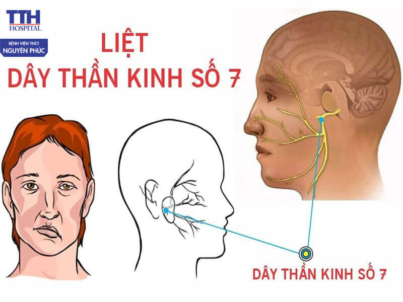Liệt dây thần kinh số VII ngoại biên là gì?