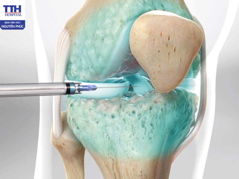 Lợi ích của tiêm chất nhờn dịch khớp trong hỗ trợ điều trị thoái hóa khớp gối