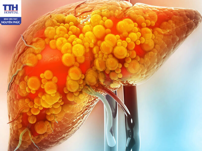 Nên thăm khám để phát hiện sớm bệnh gan nhiễm mỡ để có biện pháp điều trị