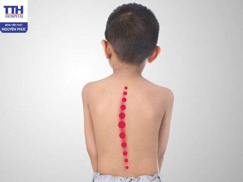 Nguyên nhân khiến trẻ bị cong vẹo cột sống ngày càng nhiều