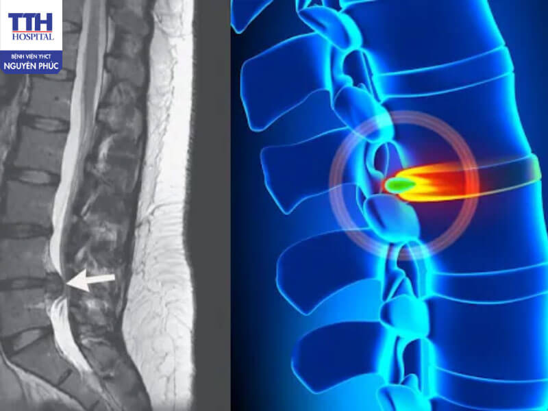 Những ai dễ mắc thoát vị đĩa đệm?