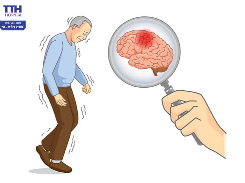 Parkinson hay còn gọi là bệnh liệt rung hoặc bệnh run tay chân