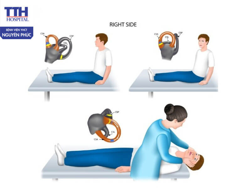 Phác đồ điều trị rối loạn tiền đình theo hướng kết hợp Y học cổ truyền