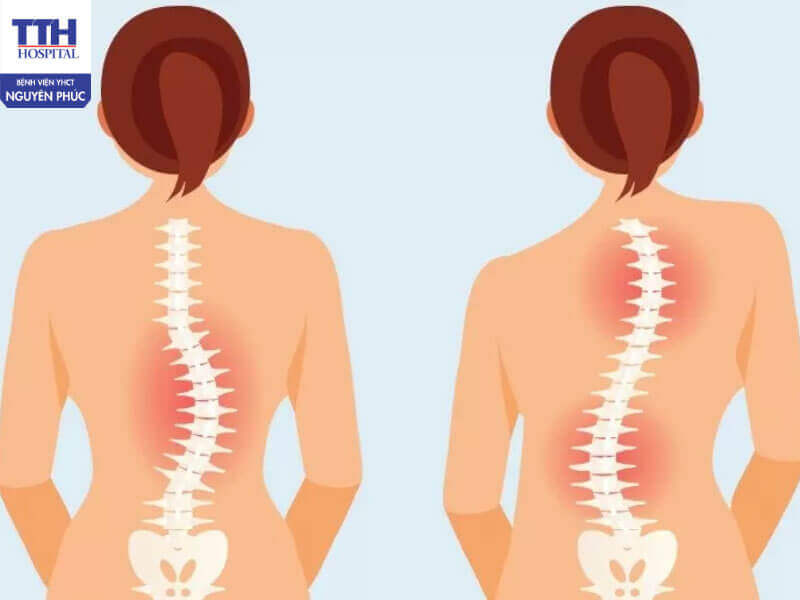 Các phương pháp hỗ trợ điều trị cong vẹo cột sống phổ biến hiện nay