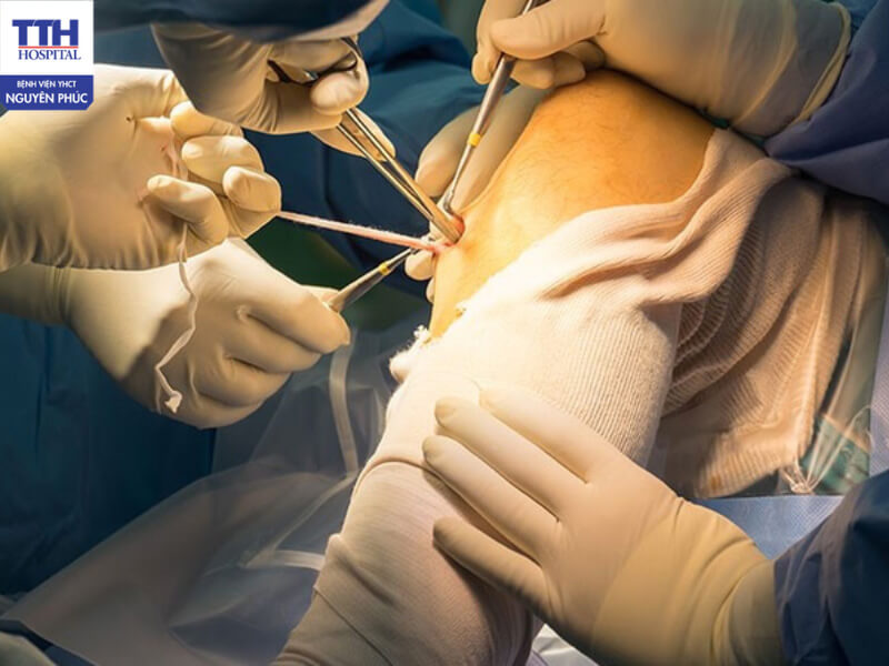 Phẫu thuật tái tạo dây chằng giúp để khôi phục lại tính ổn định của khớp gối