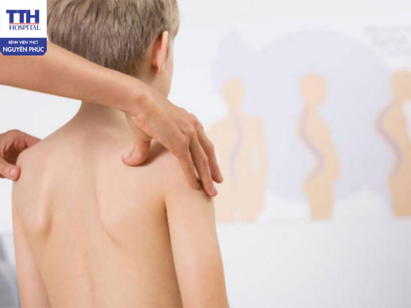 Phòng ngừa và hỗ trợ điều trị cong vẹo cột sống ở trẻ