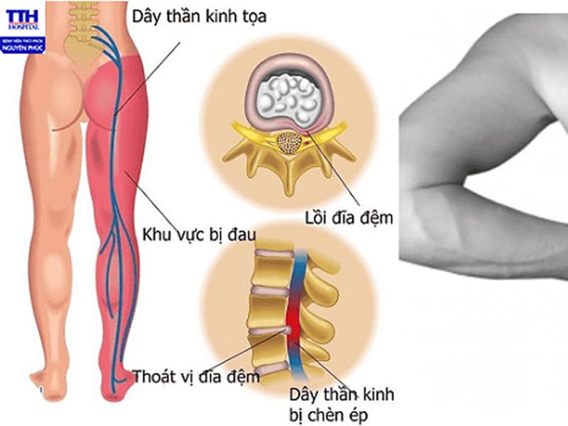 Thoát vị đĩa đệm – Căn bệnh “âm thầm” nhưng nguy hiểm