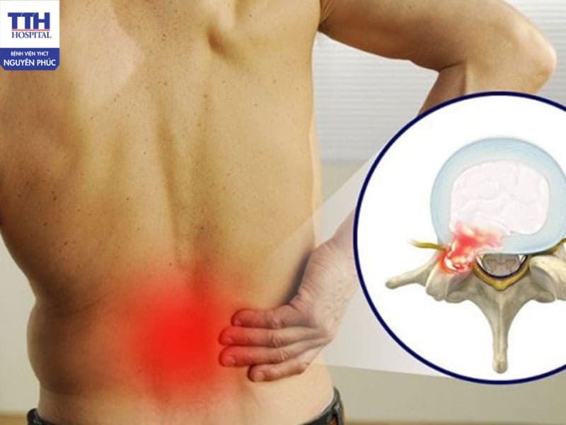 Thoát vị đĩa đệm gây ảnh hưởng nặng nề đến sức khỏe và đời sống