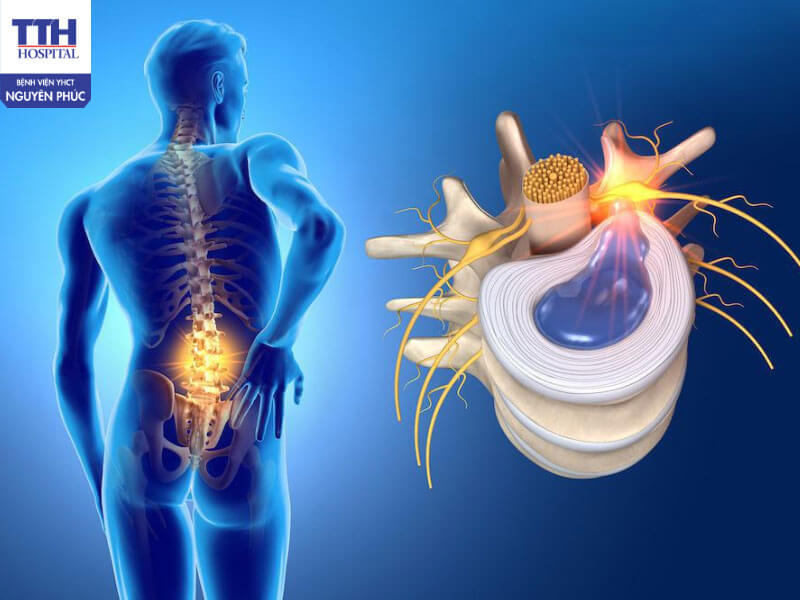 Thoát vị đĩa đệm là gì?