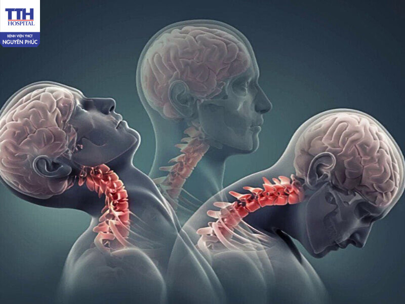 Thói quen sinh hoạt sai tư thế là nguyên nhân hàng đầu gây thoái hóa đốt sống cổ