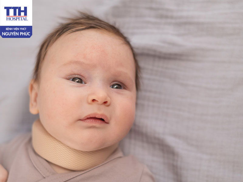 Vẹo cổ ở trẻ là gì?