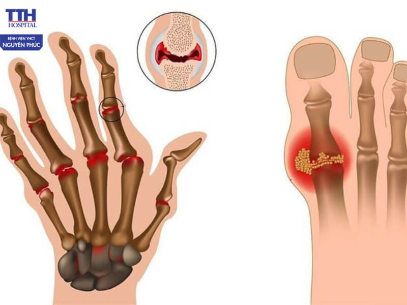 Viêm khớp dạng thấp là một bệnh lý tự miễn phổ biến, ảnh hưởng đến cuộc sống thường ngày