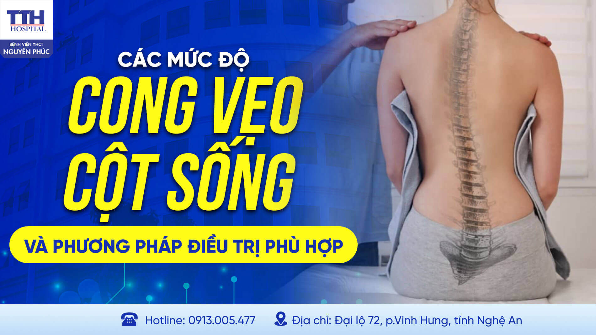 CÁC MỨC ĐỘ CONG VẸO CỘT SỐNG VÀ PHƯƠNG PHÁP ĐIỀU TRỊ PHÙ HỢP