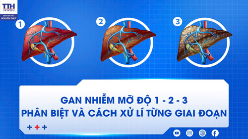 Gan nhiễm mỡ độ 1 – 2 – 3: Phân biệt và cách xử lý từng giai đoạn