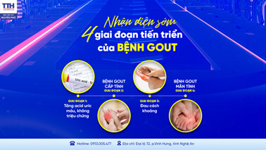 NHẬN DIỆN SỚM 4 GIAI ĐOẠN TIẾN TRIỂN CỦA BỆNH GOUT