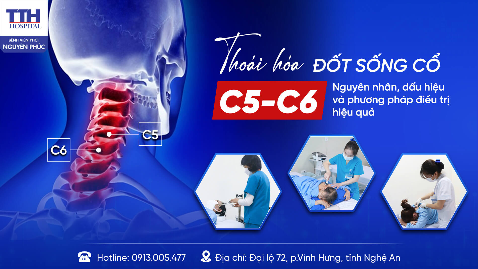 THOÁI HÓA ĐỐT SỐNG CỔ C5-C6